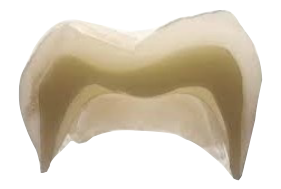 지르코니아 크라운