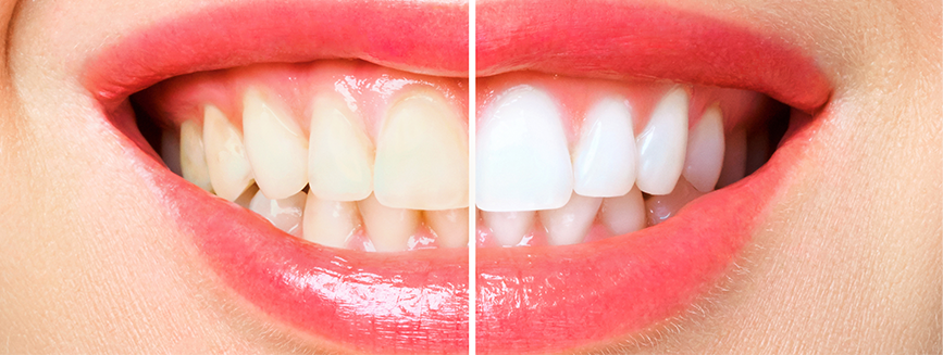 미백제 성분의 약리작용과 레이저를 이용하여 원래의 색조를 회복, 또는 더 밝게 만드는 치료입니다.