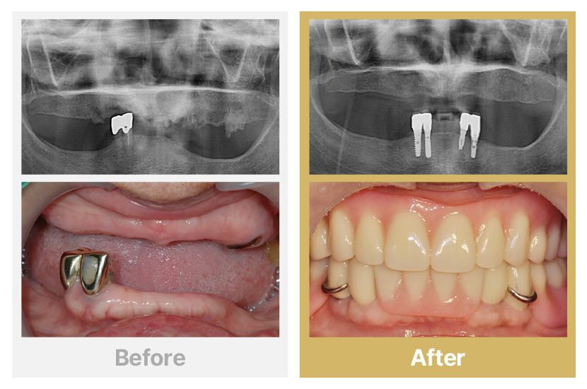 상악 전체틀니, 하악 부분틀니
