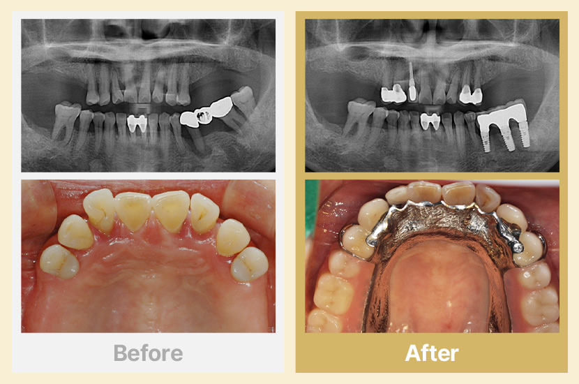 상악 부분틀니, 하악 임플란트