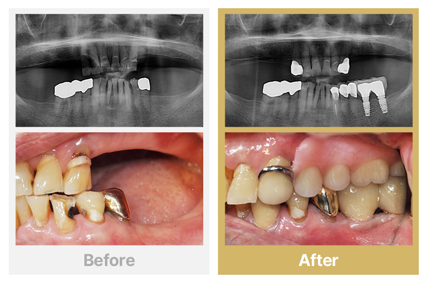상악 부분틀니, 하악 임플란트