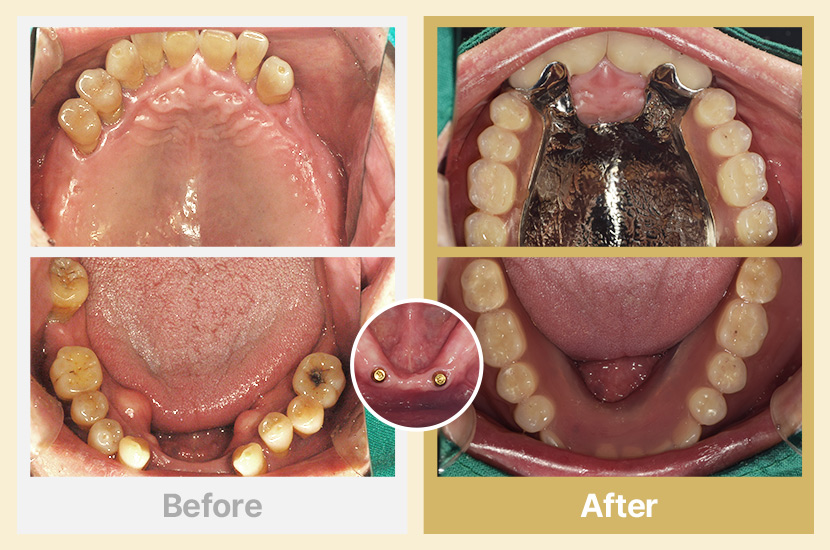 상악 부분틀니, 하악 임플란트 틀니