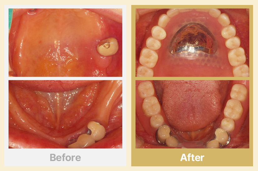 상악 전체틀니, 하악 부분틀니