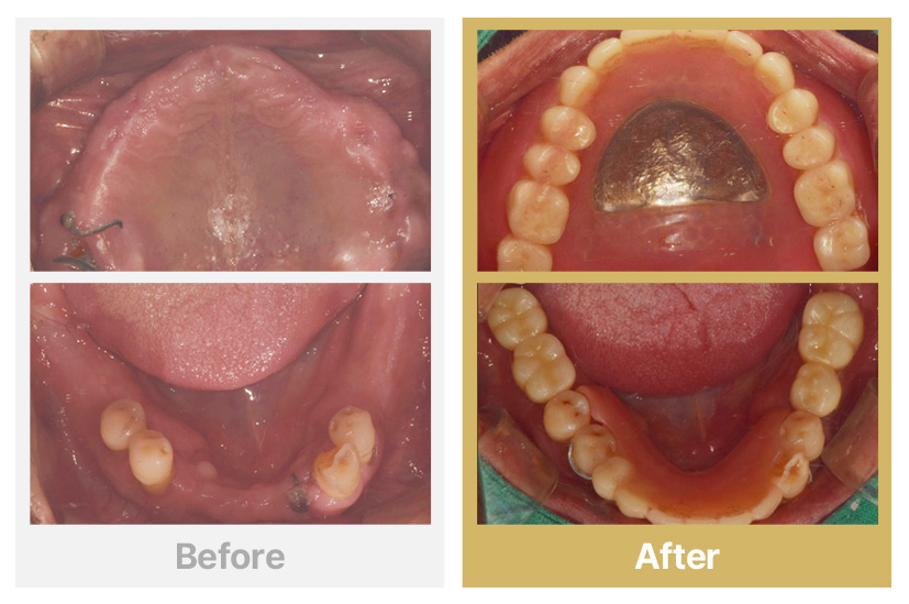상악 전체틀니, 하악 임플란트