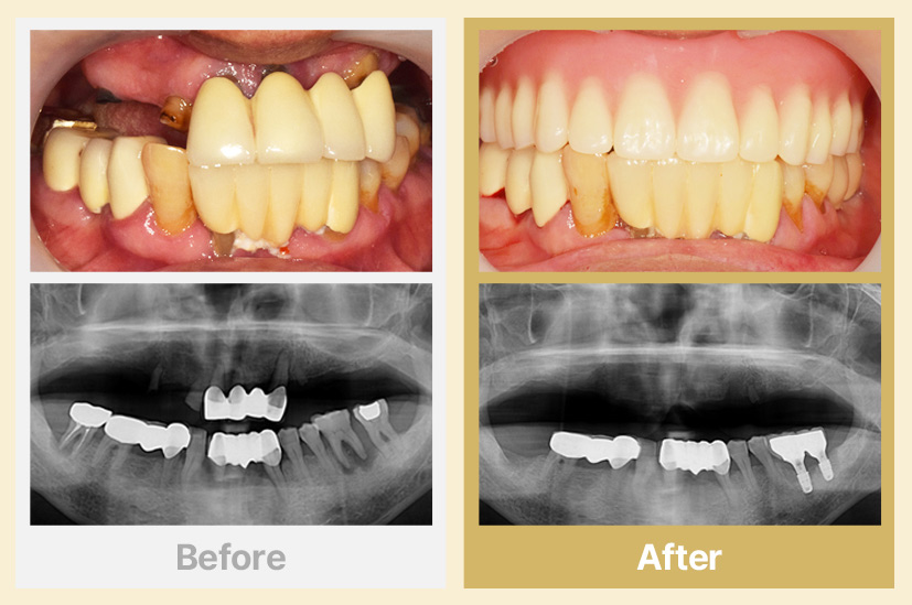 상악 전체틀니, 하악 임플란트