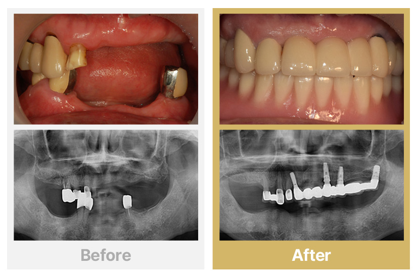 상악 임플란트, 하악 전체틀니