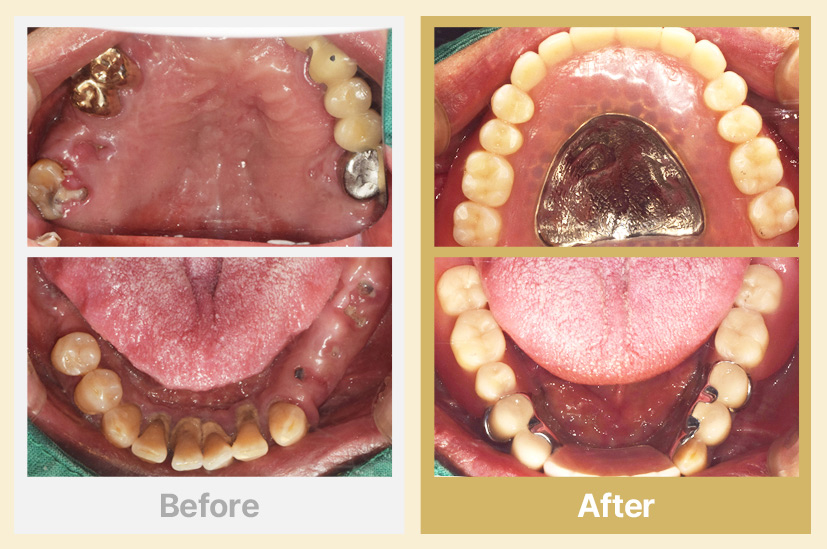 상악 전체틀니, 하악 임플란트