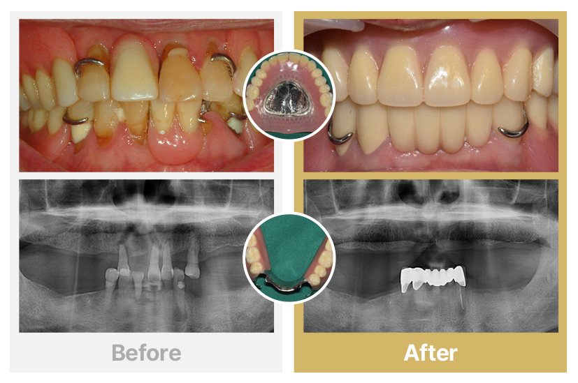 상악 전체틀니, 하악 부분틀니