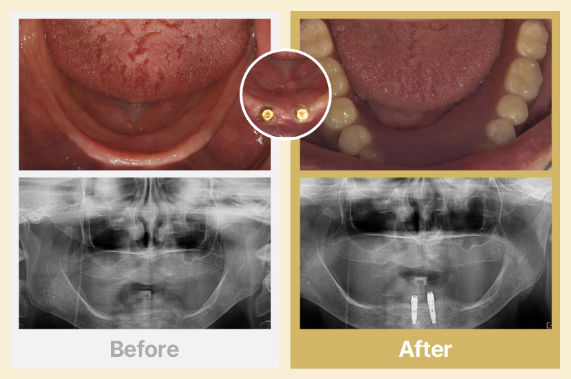 하악 임플란트 틀니