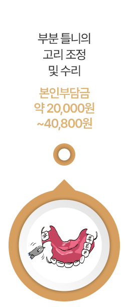 부분 틀니의 고리 조정 및 수리