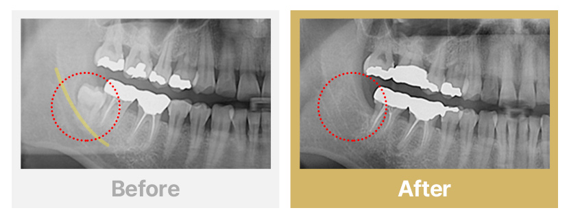 1.신경관이 겹친 매복 사랑니