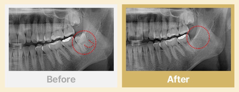 2.뿌리가 휘어진 매복 사랑니