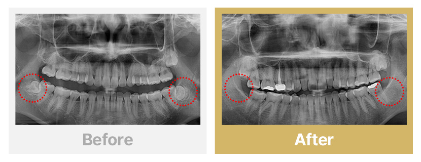 3.방향이 틀어진 매복 사랑니