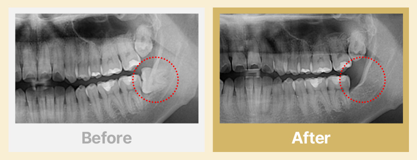 4.수평으로 맹출한 매복 사랑니 발치