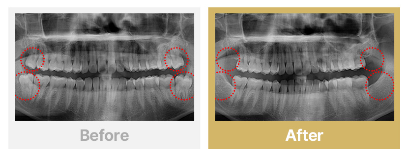 5.아래 뿌리가 휘어진 매복살아니 발치와 윗 단순사랑니 발치