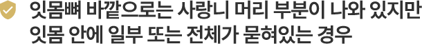 잇몸뼈 바깥으로는 사랑니 머리 부분이 나와 있지만 잇몸 안에 일부 또는 전체가 묻혀있는 경우