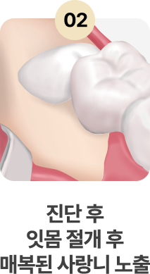 2.진단 후 잇몸 절개 후 매복된 사랑니 노출