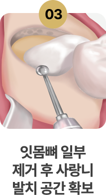3.잇몸뼈 일부 제거 후 사랑니 발치 공간 확보