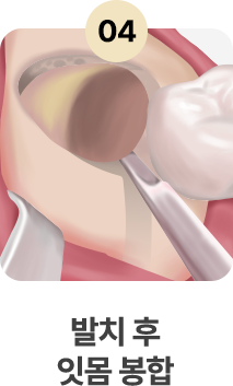4.발치 후 잇몸 봉합