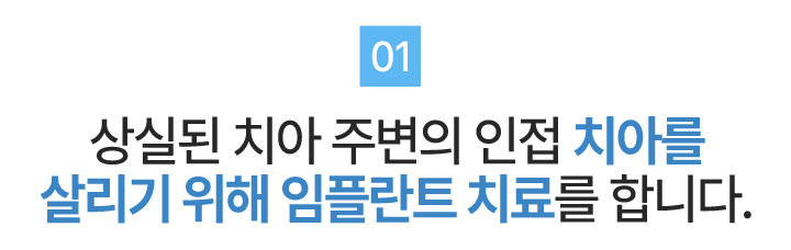 더플러스가 생각하는 임플란트 치료01