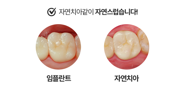 자연치아같이 자연스럽습니다