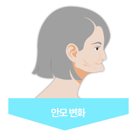 안모 변화