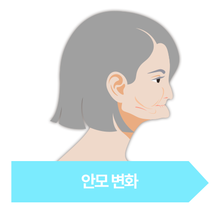 안모 변화