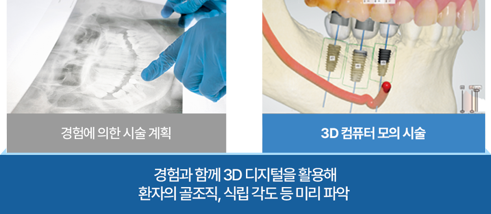 경험과 함께 3D 디지털을 활용한 골조직 및 식립 각도 파악