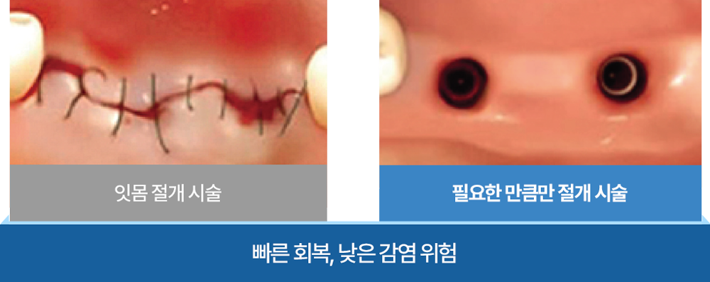 빠른 회복 낮은 감염 위험