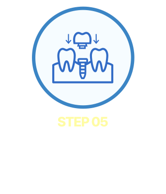 보철물 제작 후 장착