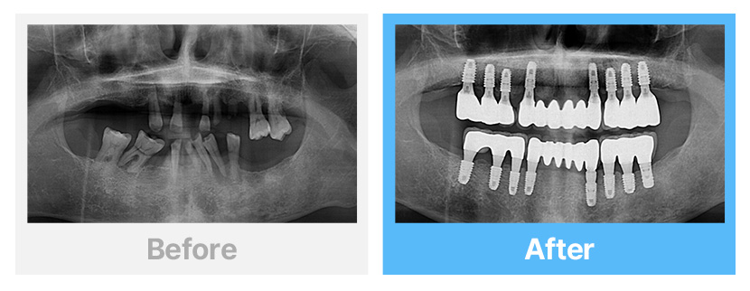 만성 치주염 환자의 전체 임플란트