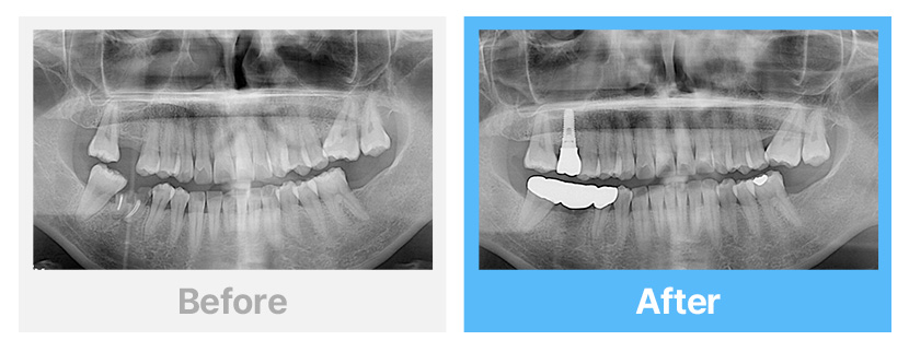 어금니 임플란트