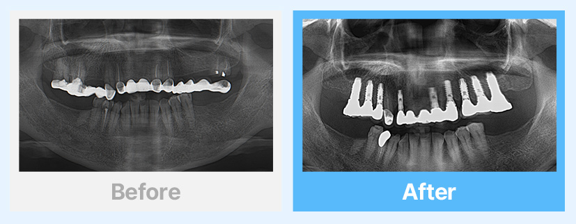 상악 full case 임플란트