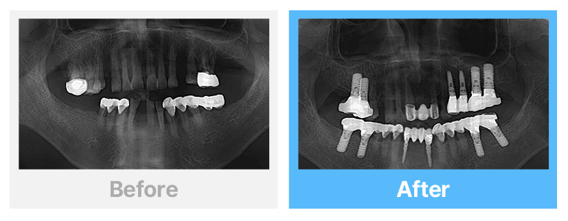 앞니, 어금니 임플란트