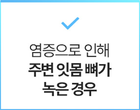 염증으로 인해 주변 잇몸 뼈가 녹은 경우