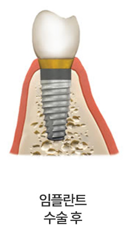 임플란트 수술 후