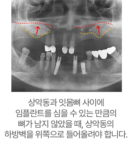 상악동과 잇몸뼈 사이에 임플란트를 심을 수 있는 만큼의 뼈가 남지 않았을 때, 상악동의 하방벽을 위쪽으로 들어올려야합니다.