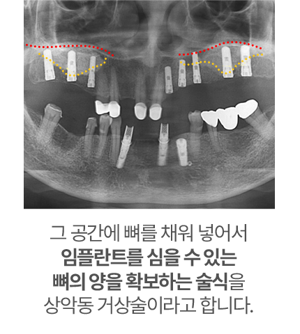 임플란트를 심을 수 있는 뼈의 양을 확보하는 술식을 상악동 거상술이라고 합니다.