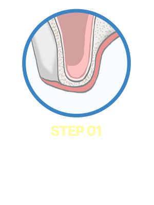 Step01. 시술 여부 검사