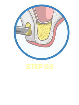 Step03. 뼈이식과 봉합