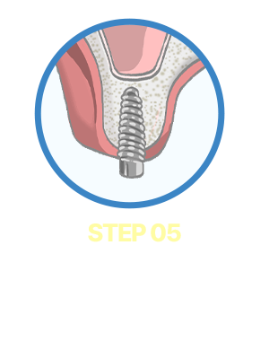 Step05. 임플란트