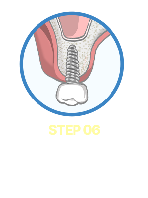 Step06. 보철완성