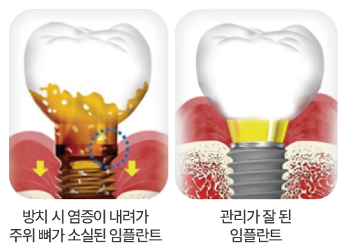 임플란트 평생 관리